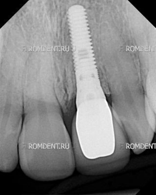 ROMDENT | Имплантационные системы