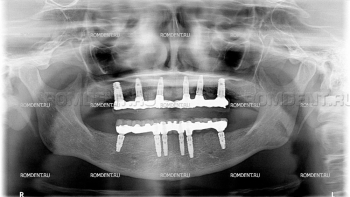 ROMDENT | Имплантационные системы
