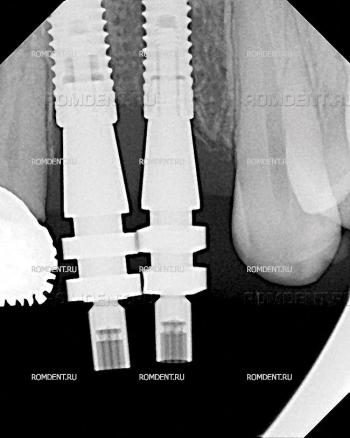 ROMDENT | Имплантационные системы