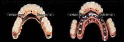 ROMDENT | Конструкции на имплантах
