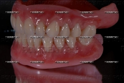 ROMDENT | Полные и частичные съемные протезы