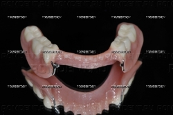 ROMDENT | Полные и частичные съемные протезы