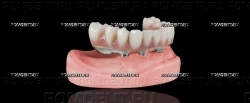 ROMDENT | Конструкции на имплантах
