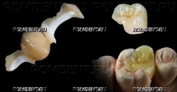 ROMDENT | Микропротезирование