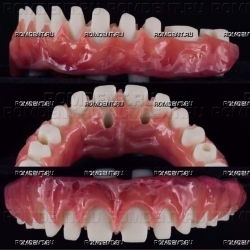 ROMDENT | Конструкции на имплантах