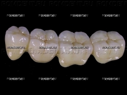 ROMDENT | Коронки