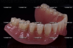 ROMDENT | Полные и частичные съемные протезы