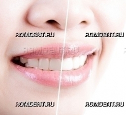 ROMDENT | Отбеливание зубов