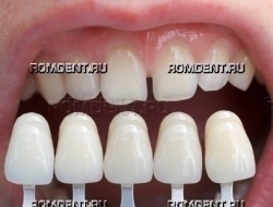 ROMDENT | Отбеливание зубов