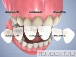 ROMDENT | Установка виниров