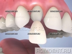 ROMDENT | Установка виниров