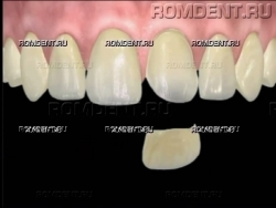 ROMDENT | Установка виниров