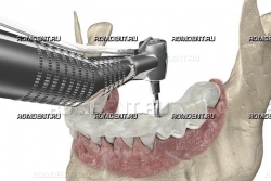 ROMDENT | Хирургический шаблон