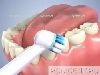 ROMDENT | Лечение десен и профилактика