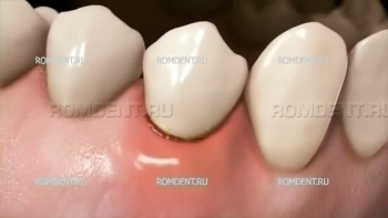 ROMDENT | Gum Treatment and Prevention