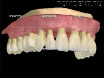 ROMDENT | Gum Treatment and Prevention