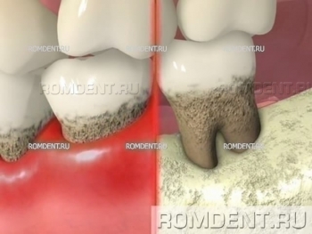 ROMDENT | Лечение десен и профилактика
