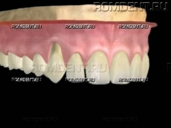 ROMDENT | Повышенная чувствительность зубов