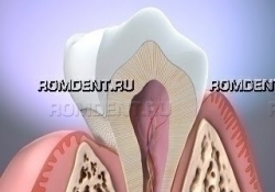 ROMDENT | Повышенная чувствительность зубов