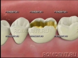 ROMDENT | Кариес