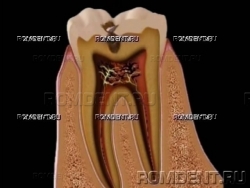 ROMDENT | Кариес