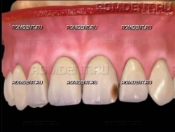 ROMDENT | Кариес