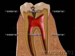 ROMDENT | Осложненный кариес