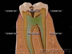 ROMDENT | Осложненный кариес