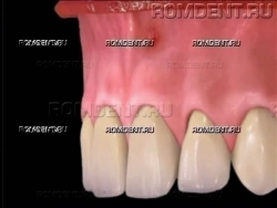 ROMDENT | Осложненный кариес