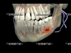 ROMDENT | Осложненный кариес