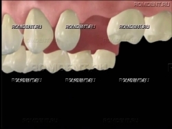 ROMDENT | Протезирование одного зуба