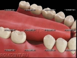 ROMDENT | Протезирование одного зуба