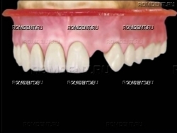 ROMDENT | Протезирование одного зуба