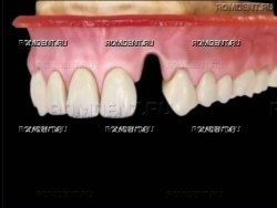 ROMDENT | Протезирование одного зуба