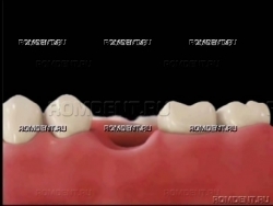 ROMDENT | Протезирование одного зуба