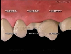 ROMDENT | Протезирование одного зуба