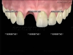 ROMDENT | Протезирование одного зуба