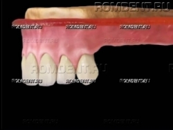 ROMDENT | Отсутствие нескольких зубов