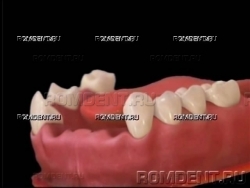 ROMDENT | Отсутствие нескольких зубов