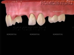 ROMDENT | Отсутствие нескольких зубов