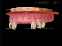 ROMDENT | Отсутствие нескольких зубов
