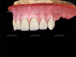 ROMDENT | Отсутствие нескольких зубов