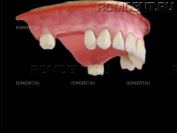 ROMDENT | Отсутствие нескольких зубов