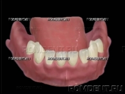 ROMDENT | Отсутствие нескольких зубов
