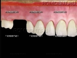 ROMDENT | Отсутствие нескольких зубов