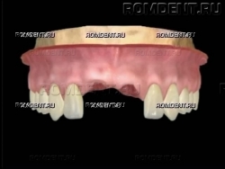 ROMDENT | Отсутствие нескольких зубов