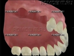 ROMDENT | Отсутствие нескольких зубов