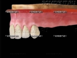 ROMDENT | Отсутствие нескольких зубов