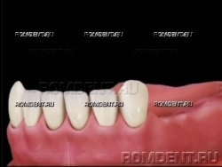 ROMDENT | Отсутствие нескольких зубов