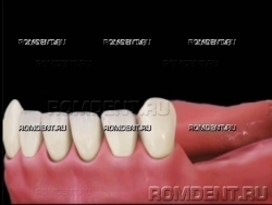 ROMDENT | Отсутствие нескольких зубов